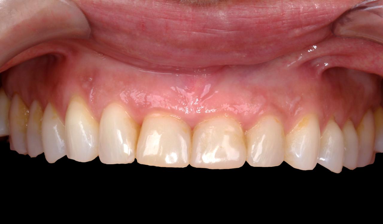 Sorriso antes do tratamento com lentes de contato dental