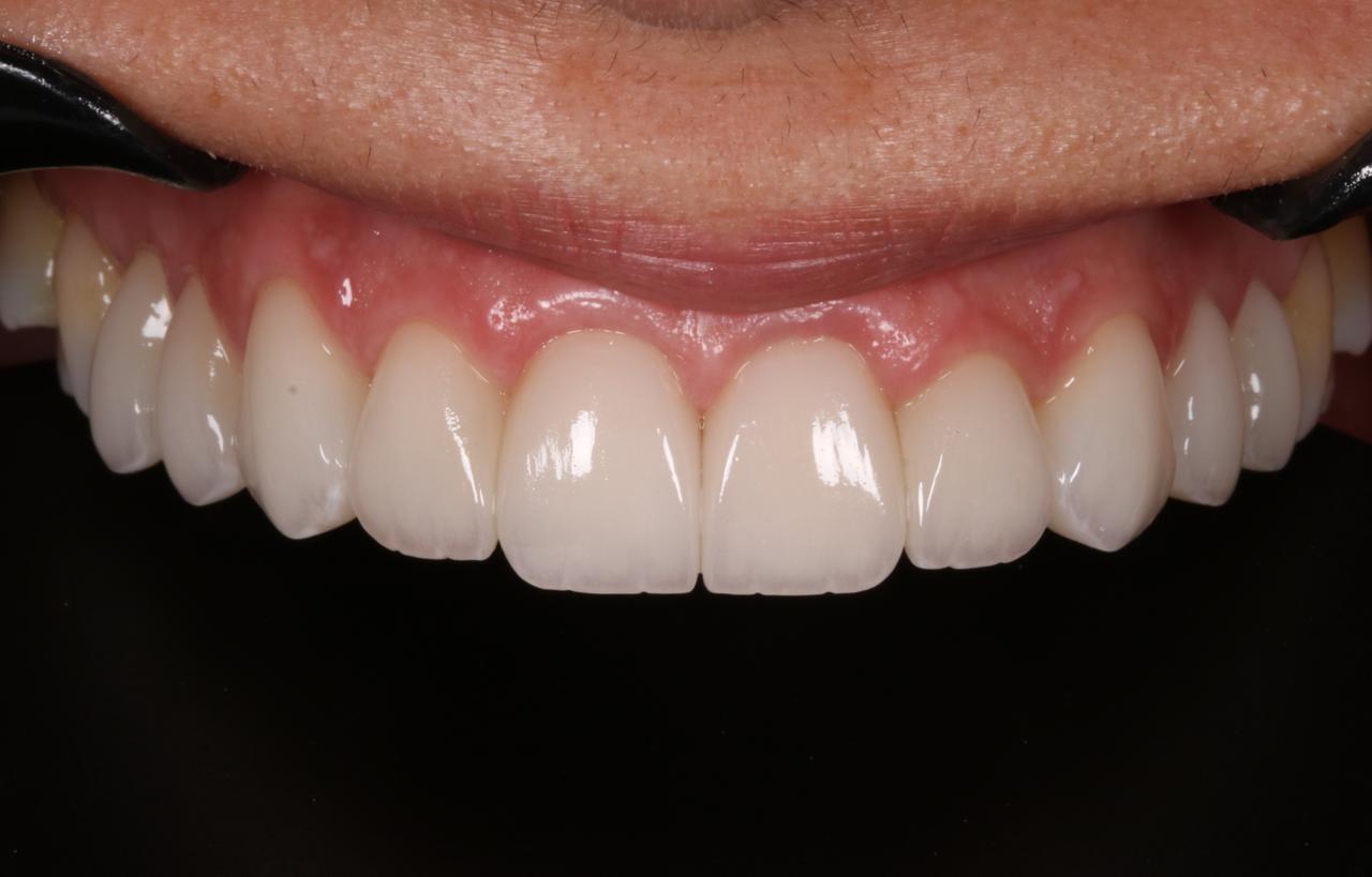 Sorriso depois do tratamento com lentes de contato dental
